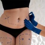 Liposuction-123.jpg
