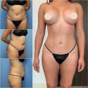 How Body Contouring in Dubai Helps Shape and Define Your Body