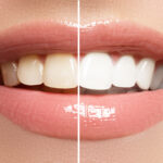 Safe-and-Simple-Teeth-Whitening-That-Works_11zon.jpg