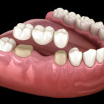 dental-crown.jpg