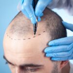 hair-transplant.jpeg