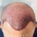 hair-transplant-in-islamabad.jpg