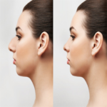 تجميل-الأنف-before-and-after.png