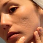 Acne-Scars-Treatment-in-Islamabad.jpg