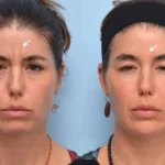 H4-botox.webp