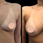 H6-Breast-Augmentation.jpg