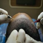 Hair-transplant-in-Islamabad.jpg
