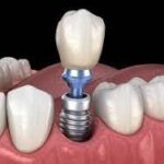 How-Long-Do-I-Have-to-Wait-Between-Tooth-Extraction-and-Implant-in-Dubai.jpg