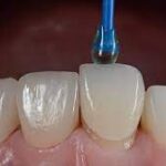 Invisible-tooth-repair-agent.jpg