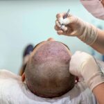 Is-hair-transplant-surgery-safe.jpg
