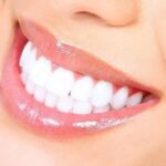 Laser-teeth-whitening-treatment-in-Islamabad.jpg