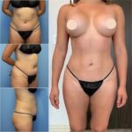 Liposuction-pictures.jpg