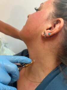 Top Questions About Skin Tag Removal Cost in Sheffield, Answered