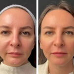 Mesotherapy.jpg