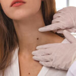 Mole-Removal.jpg
