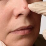 Skin-Wart-Removal.jpg