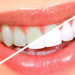 Teeth-Whitening.jpg