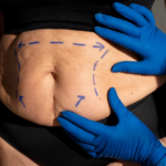 What-Happens-If-I-Gain-Weight-After-Abdominal-Liposuction.png