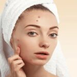 acne-and-scar-treatments-1.jpeg