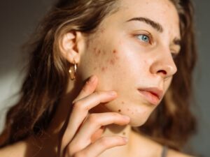Is Chemical Peel a Good Option for Acne Scar Treatment?