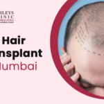 fue-hair-transplant-in-mumbai.png