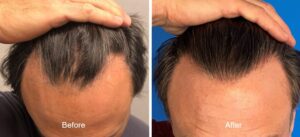 Why Hair Transplants in Albania Are Gaining Global Popularity