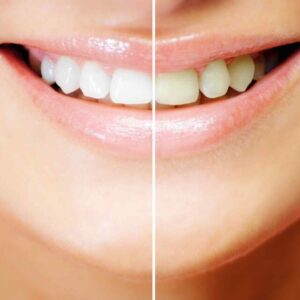 Teeth Whitening Service In Meadowvale | Meadowvaledentist.ca