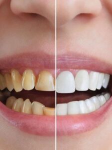 Dental Veneers Oakville | Tremainedental.com
