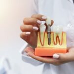 imgi_5_Dental-Implants.jpeg