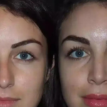 rhinoplasty-in-dubai-1.png