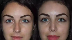 What to Expect During Rhinoplasty Recovery in Dubai