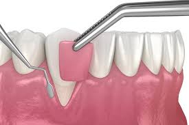 Do Dental Implants Cause Gum Disease?
