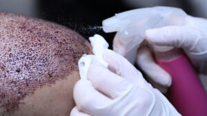 How Long to Avoid Sun After Hair Transplant Surgery?