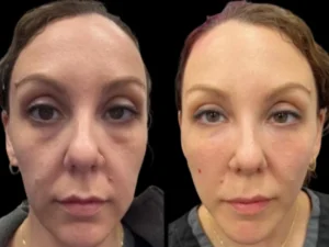 Is Dark Circles Treatments in Dubai Painful Here’s What to Expect