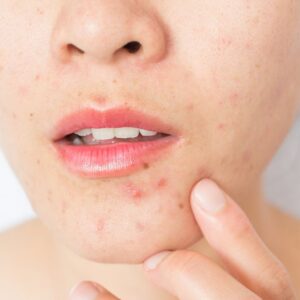 Discover Clearer Skin with the Best Acne Treatment Facial Near You
