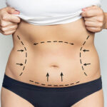 Before-Tummy-Tuck.jpg