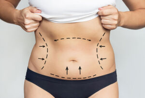 Liposuction Surgery in Dubai: A Complete Guide to the Procedure
