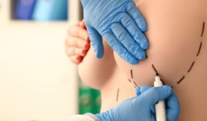 What Is the Typical Consultation Process for Breast Reduction in Riyadh?
