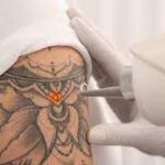 Can-All-Tattoos-Be-Erased-Permanently-With-Lasers.jpg