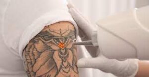 Can All Tattoos Be Erased Permanently With Lasers?