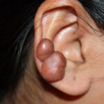Can-Keloids-Be-Removed-from-Piercings.jpg