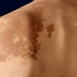Can-Laser-Help-in-Birthmark-Removal-Treatment.jpg