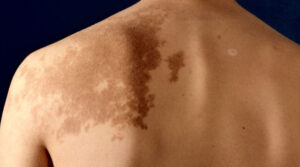 Can Laser Help in Birthmark Removal Treatment?