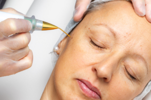 Can Plasma Pen Treat Wrinkles and Fine Lines?