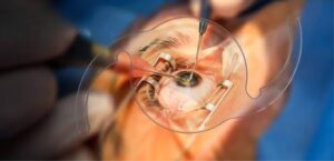 Laser Cataract Surgery: Precision Eye Care at Dr. Agarwal