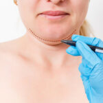 Chin-Reduction.jpg