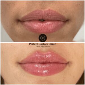 Juvederm for Fuller Hands: Insights from the Best Doctors in Dubai