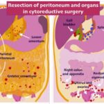 Cytoreductive-Surgery-in-Ahmedabad.jpg