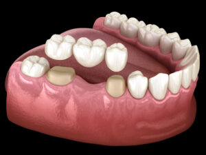 Crown Your Tooth for Strength and Beauty