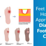 Diabetic-Foot-Ulcer.jpg